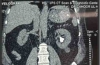 经皮肾镜取石术（PCNL）后肾造瘘导管误入肾静脉一例报告及文献综述