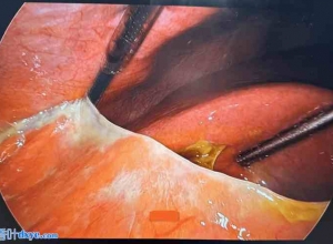 腹腔镜治疗无结石性胆囊炎自发性胆囊穿孔：病例系列