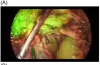 吲哚菁绿在荧光引导胰腺手术中的作用：综合综述
