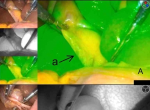 腹腔镜胆囊切除术中吲哚菁绿荧光胆管造影的益处、问题及最佳施术时机
