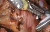 机器人腹腔镜辅助胆囊管结扎治疗Roux-en-Y胃绕道手术患者术后持续性胆漏