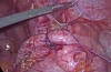 腹腔镜阑尾切除术治疗粘连于髂骨的盆腔阑尾炎