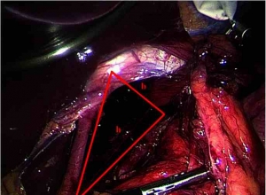 一种可重复测量食管裂孔的方法及其在食管裂孔疝修补术中的潜在应用