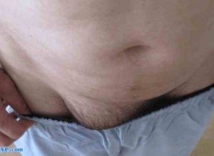 一次腹腔镜经腹膜前入路手术修补五处同步性腹股沟疝（双侧外侧疝、股疝和右侧内侧疝）