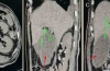 伴有粘液囊肿和结石的症状性胆囊重复畸形：CT 诊断的解剖变异