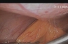 腹腔镜解剖腹股沟疝 手术视频 回贴就可下载