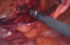 关键步骤_解剖_腹腔镜腹股沟疝修补术（TAPP）自抓网和胶水