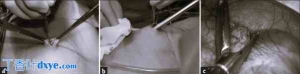 经脐腹腔镜辅助阑尾切除术对儿童的效果优于腹腔镜阑尾切除术吗？一项随机对照研究