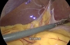 1型Mirizzi综合征低位残留胆管结石的再次腹腔镜手术