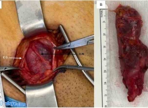 成年女性努克氏管囊肿：手术治疗病例报告