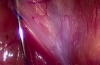 腹股沟疝_腹腔镜双侧疝切开术