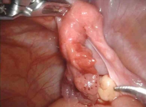 成年女性腹股沟直疝含输卵管：一例罕见病例报告