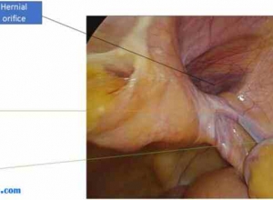 单纯性VII因子缺乏症合并Amyand疝的术前诊断及腹腔镜治疗：病例报告