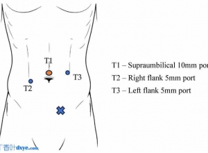 腹股沟疝修补术的现代视角：手术技术、网片选择和固定策略的叙述性综述
