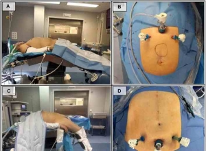 采用完全腹膜外入路联合腹膜前修补术治疗正中疝缺损：病例系列及单中心经验