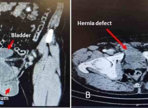 腹腔镜治疗复发性腹股沟疝（含膀胱）：病例报告及文献综述
