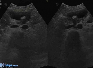 腹腔镜胆囊切除术治疗胆囊扭转：一例原始病例报告