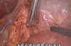 腹腔镜治疗十二指肠溃疡穿孔