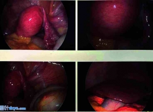 微创治疗苗勒氏管畸形：临床决策系统
