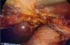 腹腔镜胆囊切除术中发现先天性胆囊肝管