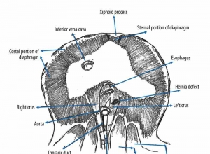 机器人辅助手术修复食管裂孔疝：病例报告