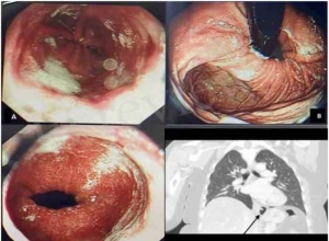 腹腔镜下食管裂孔疝修补术和尼森胃底折叠术后单侧眼眶手术性皮下气肿：病例报告