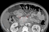 坏死性胰腺炎患者脐疝修补术中意外出现乳糜性腹水一例报告