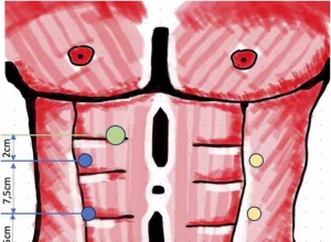 机器人辅助腹膜外腹壁疝修补术——采用侧方eTEP和eTAR技术连续160例手术的经验