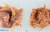 空肠异位胰腺慢性胰腺炎：慢性腹痛的罕见病因