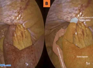 经腹膜前入路（TAPP）治疗Spigelian疝：作者的临床经验和文献综述