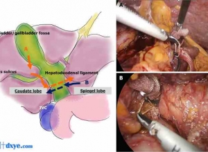 肝表面引导下环绕肝十二指肠韧带在微创重复肝切除术中Pringle阻滞术中的应用