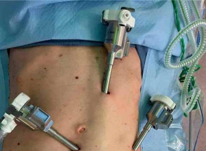 机器人辅助经腹膜外疝修补术