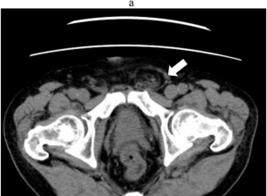 经对侧高位腹膜切口入路腹腔镜修补复发性腹股沟疝：病例报告