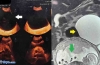 妊娠20周时腹腔镜治疗20厘米卵巢浆液性囊腺瘤：病例报告