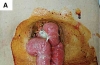 腹腔镜肝切除术后股前外侧皮瓣修复切口疝破裂并顽固性腹水一例报告