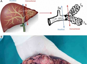 以扩张的胆管为解剖标志引导腹腔镜左侧肝切除术治疗肝内胆管结石：单中心初步研究