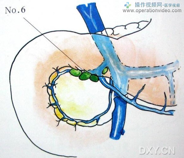 No.6淋巴结.jpg