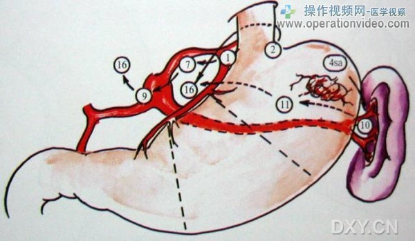 C．病变在U区淋巴结转移方向.jpg