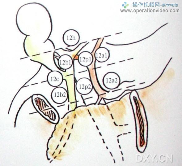 No.12与No.13淋巴结的分界线为胰腺上缘，胰腺上缘处的淋巴结为No.12淋巴结。 No.12h .jpg