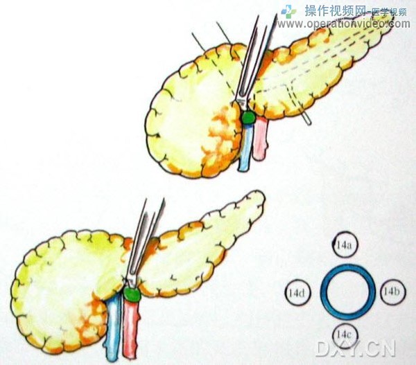 肠系膜根部淋巴结肠系膜根部淋巴结（No.14）分布于肠系膜血管根部。根据淋巴结与肠系.jpg