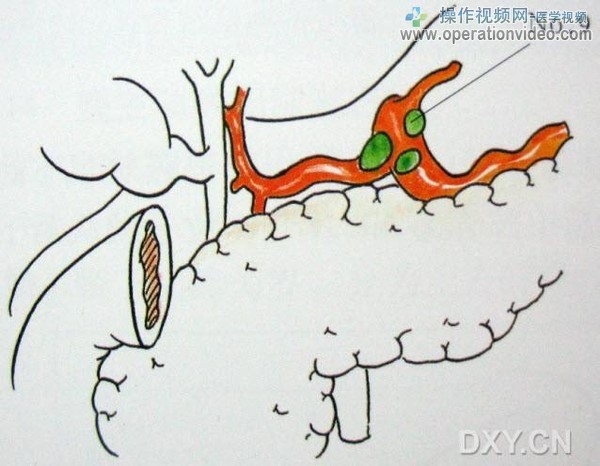 腹腔动脉周围淋巴结腹腔动脉周围淋巴结（No.9）分布于由腹腔动脉发出的胃左动脉、肝总.jpg