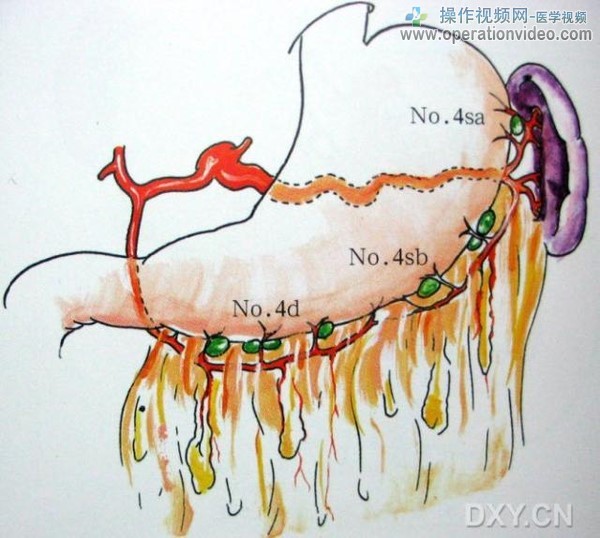 大弯淋巴结大弯淋巴结分布于整个胃大弯侧的淋巴结，又分为沿胃网膜右动脉分布的No.4d.jpg