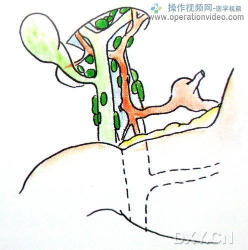 肝十二指肠韧带内淋巴结肝十二指肠韧带内淋巴结（No.12）分布于肝蒂内结缔及脂肪组织.jpg