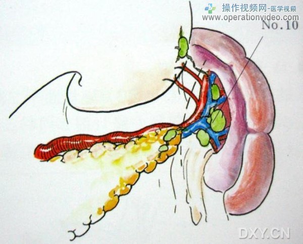 脾门淋巴结脾门淋巴结（No.10）分布于脾门处动、静脉之间结缔组织内。No.10淋巴结与No.jpg