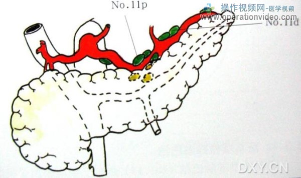 脾动脉干淋巴结脾动脉干淋巴结（No.11）分布于脾动脉干周围。包括胰尾后面的淋巴结。.jpg