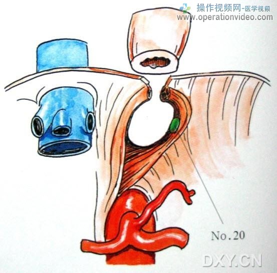 食管裂孔淋巴结食管裂孔淋巴结（No.20）位于膈肌与食管之间结缔组织中。.jpg