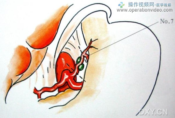 胃左动脉干淋巴结胃左动脉干淋巴结（No.7）分布于胃左动脉干上。其范围从胃左动脉根部.jpg