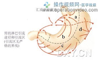 胃周围的淋巴分布十分丰富，按其引流方向可分为四个区域 a．胃小弯区（胃左淋巴结） b.jpg