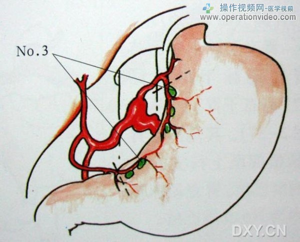 小弯淋巴结小弯淋巴结（No.3）系由胃左动脉与胃右动脉共同构建的小网膜（胃左动脉上行.jpg