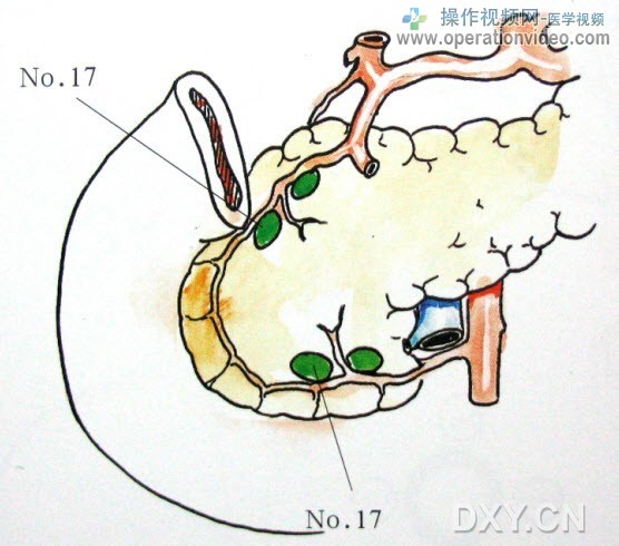 胰头前淋巴结胰头前淋巴结（No.17）位于胰头前侧，沿胰十二指肠前动脉弓分布。.jpg